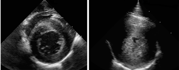A short axis echocardiogram image is shown at the level of the left ventricle during contraction. The normal (control animal) heart is seen on the left, the LVH affected animal's heart is seen on the right. The hypertrophy has nearly obliterated the entire left ventricular lumen.